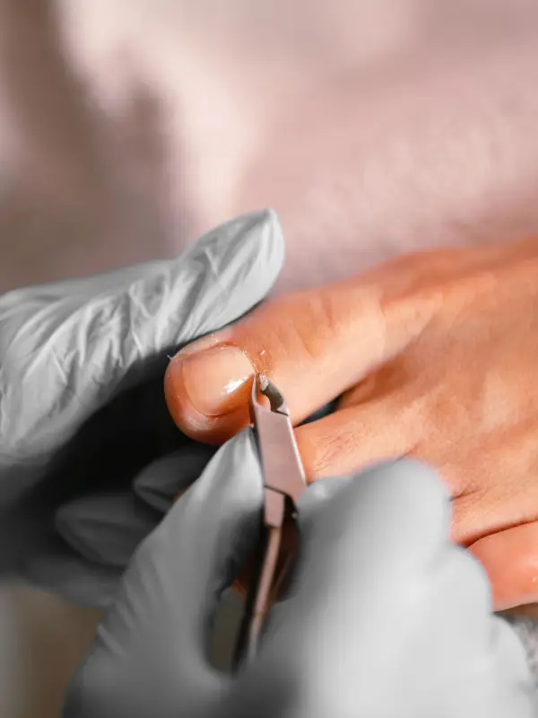 A podologist in gloves treats a toenail with nippers